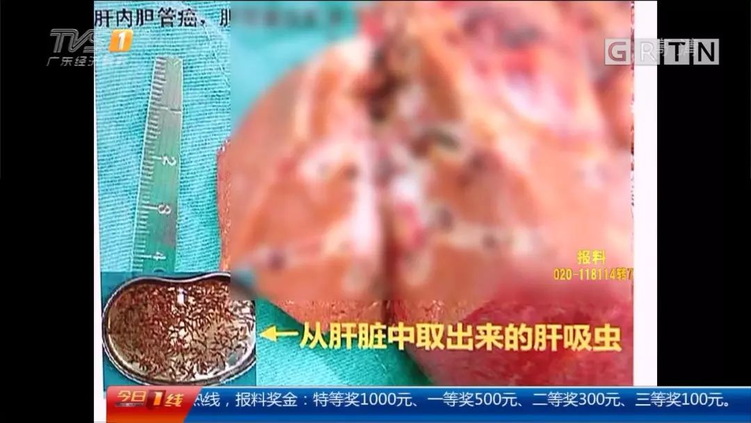 吃生鱼片患肝吸虫病_肝片形吸虫和姜片吸虫_中国患肝一般能活几年