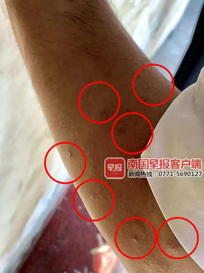 被跳蚤咬伤的工作人员手臂上多处红肿起包.