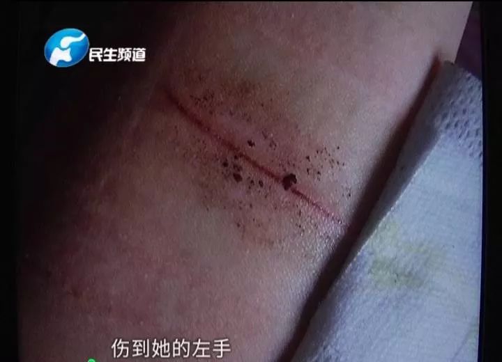 啤酒瓶突然爆炸 河南新乡14岁男孩被割伤!