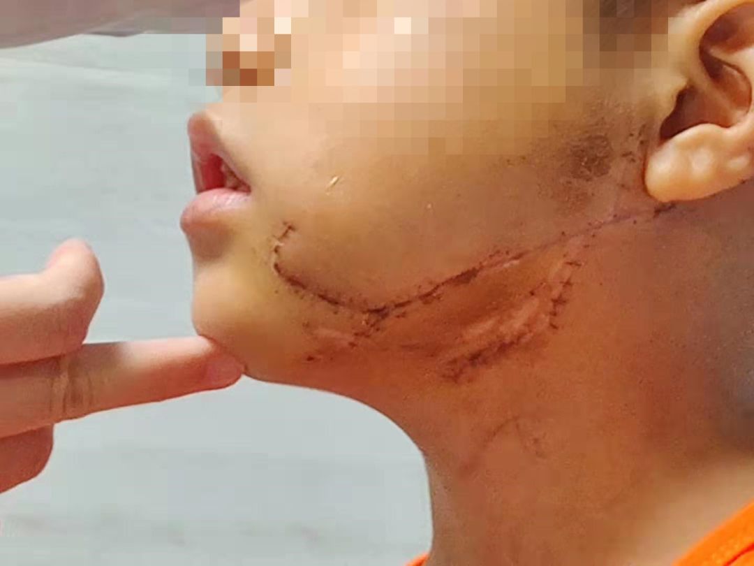 南宁8岁男孩面部撕裂伤 手术历时7小时 缝了几十针