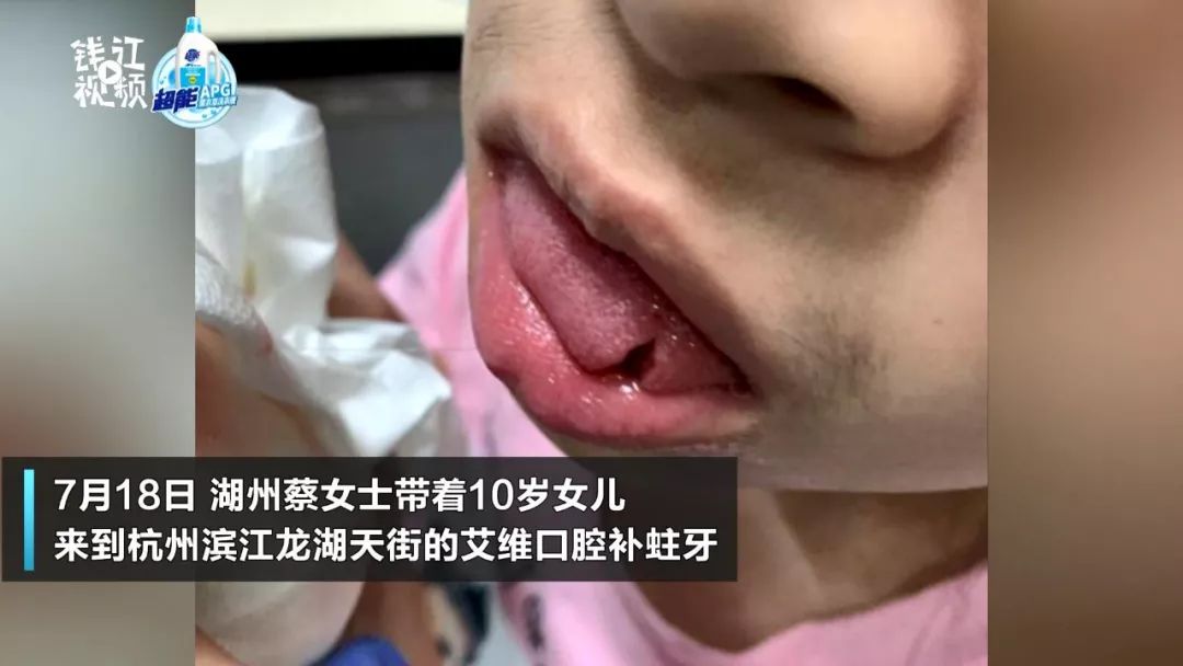 缝了8针!补牙舌头被割破 艾维口腔回复不知道"怎么赔"